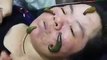 Woman treated with leeches to remove facial pimples