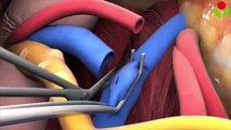 Kidney transplant videos – How to performed kidney transplantation