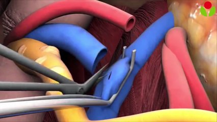 Kidney transplant videos – How to performed kidney transplantation
