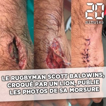 Croqué par un lion, le rugbyman Scott Baldwins publie les photos de la morsure