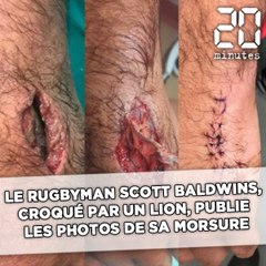 Croqué par un lion, le rugbyman Scott Baldwins publie les photos de la morsure
