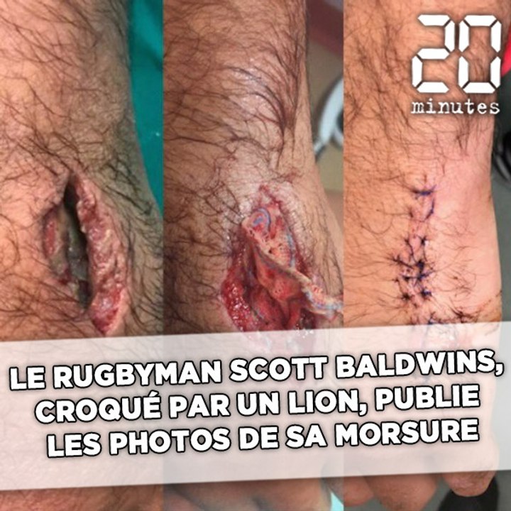 Croqué par un lion, le rugbyman Scott Baldwins publie les photos de la morsure