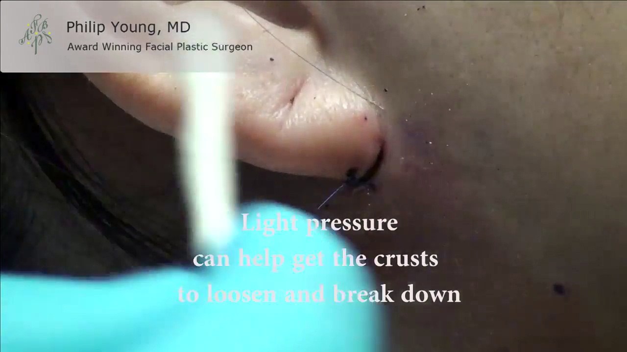 How to Clean Your Incisions for Less Scarring & Better Healing by Seattle Bellevue's Dr. Young