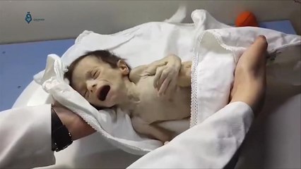 ارتفاع وفيات الأطفال بالغوطة الشرقية بسبب حصار النظام