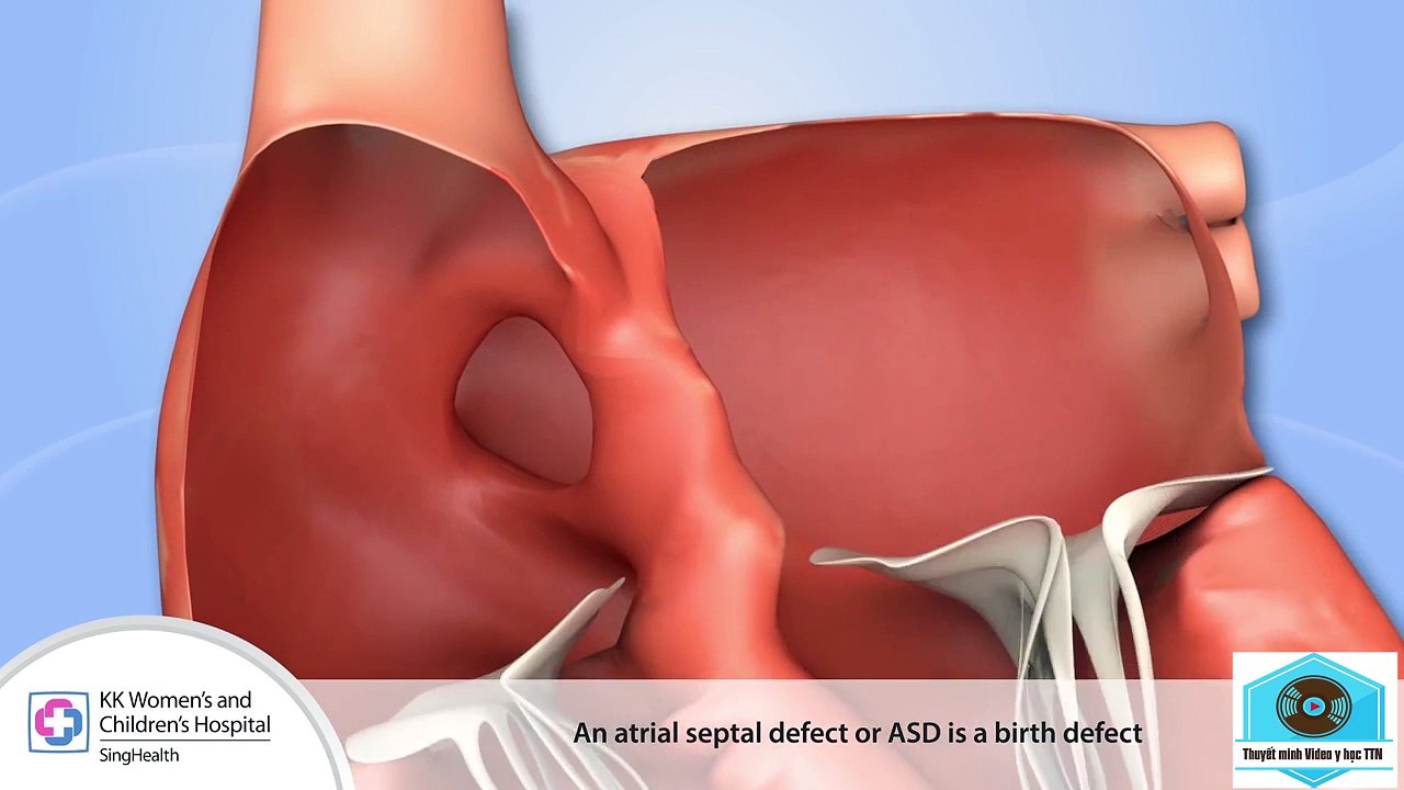 ASD1
