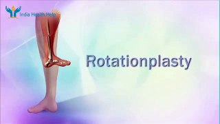 Limb Prosthesis Surgery in India | Rotationplasty Surgery