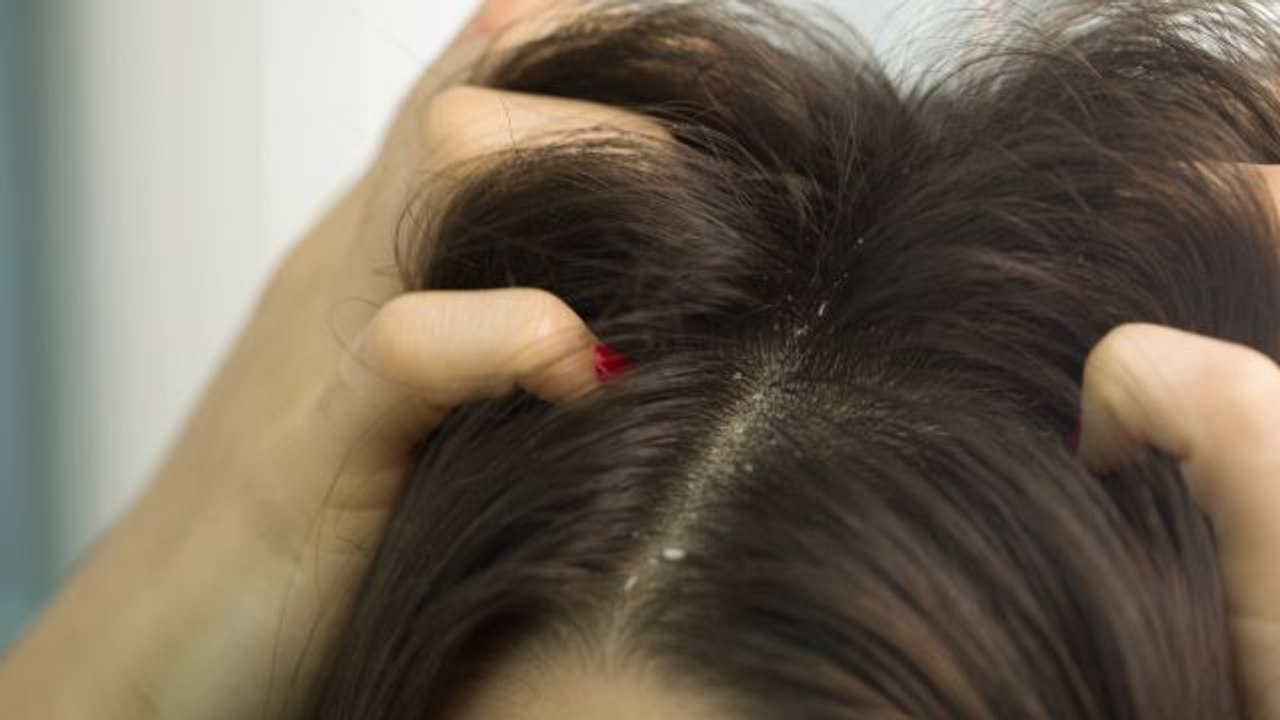 6 Common Dandruff Myths