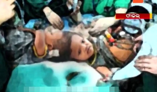 Hint Cerrahlar Başlarından Yapışık İkizleri 16 Saat Süren Ameliyatla Ayırdı