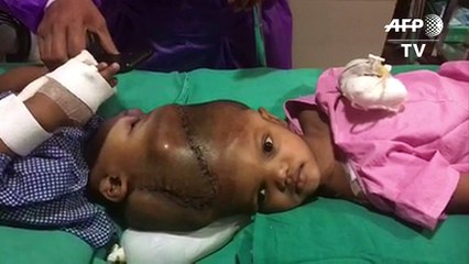 Separan en India a dos siameses unidos por la cabeza