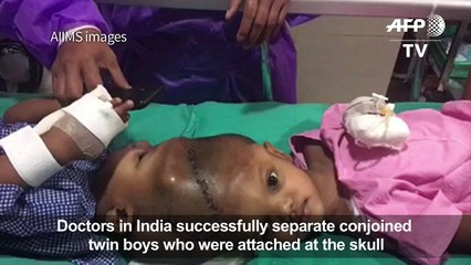 Indian doctors separate twins joined at the head