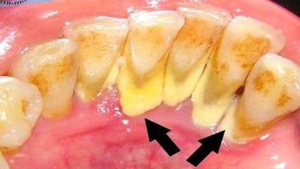 Importancia del enjuague bucal