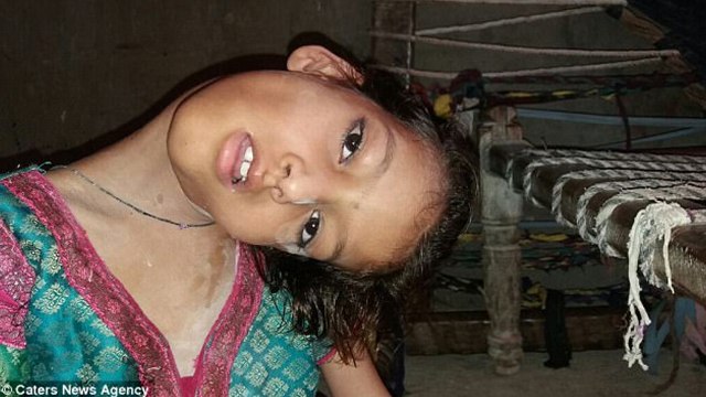 Pakistani girl's head hangs at a 180-degree angle