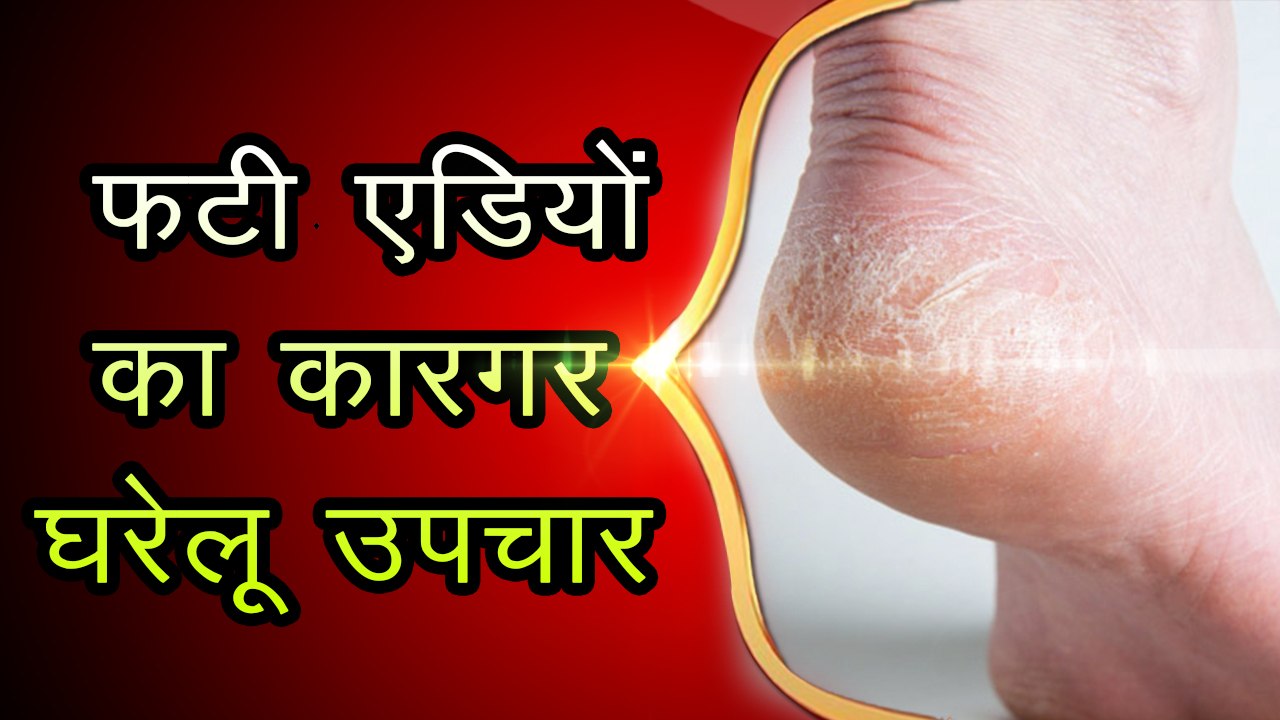 "फटी एड़ियों" का उपचार करने के घरेलू नुस्खे-fati ediyon ka Ilaj-Cracked heel homemade remedy