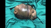 Des siamoises attachés par le crâne, ont été séparées au court d’une opération de 19 heures