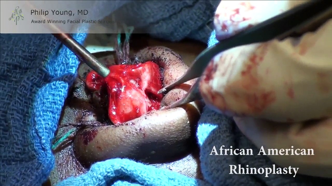 Live Surgery African American Black Ethnic Rhinoplasty Nose Job by Seattle Bellevue's Dr. Young