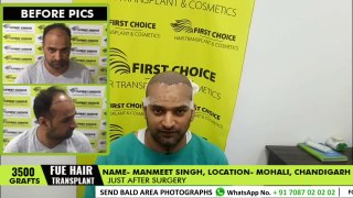 Patient Reviews - 3500 Grafts Hair Transplantation in Ludhiana @FCHTC Clinic