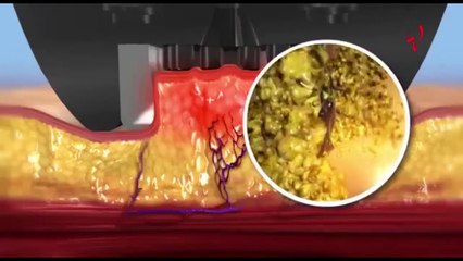 7 نصائح للوقاية من خطر الموت بسبب جراحة شفط الدهون