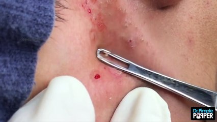 Blackheads on a Young Teenagers Face