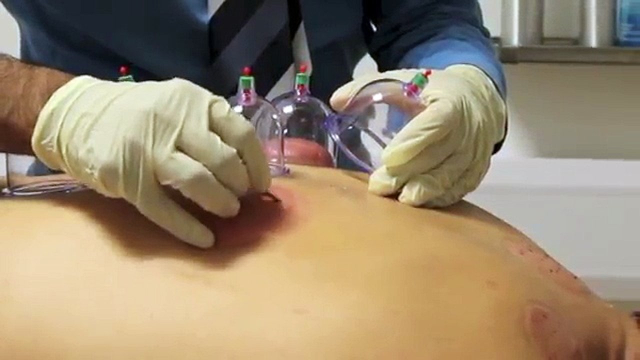 Performing Hijama (Wet Cupping) at Cardiff Hijama Center UK - Testimonial By Mustafa