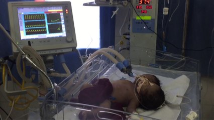 En Inde, un bébé est né avec deux têtes