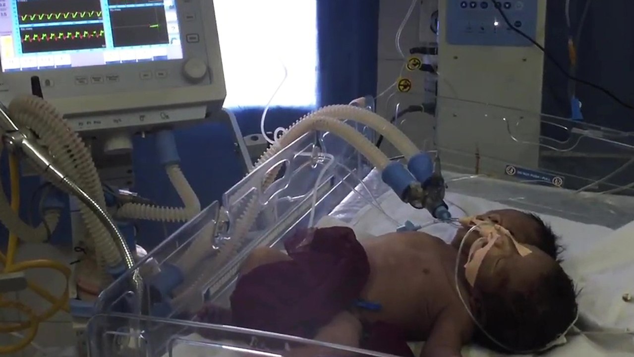 Un bébé né avec deux têtes