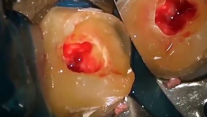 Kanal tedavisi nasıl yapılır ?