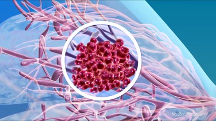 Chỉ vì 2 thói quen đáng tiếc này mà cánh đàn ông đã khiến vợ yêu bị ung thư vú