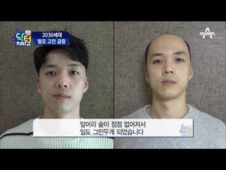 탈모 인구 천만?! 2030세대 직격! 청년도 가발 벗으면 노인?