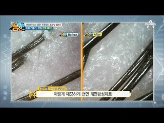 (실화주의) '소프넛 샴푸' 사용 후 두피 상태?! 두피 기름기, 각질 완벽 제거!