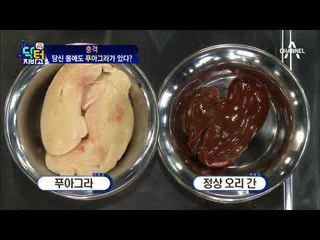 충격과 공포! 내 몸속에 푸아그라가 있다?! #지방간 #간암