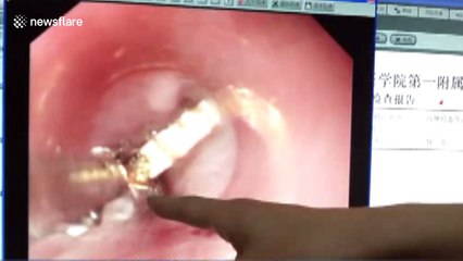 Man swallows wife's medal after argument