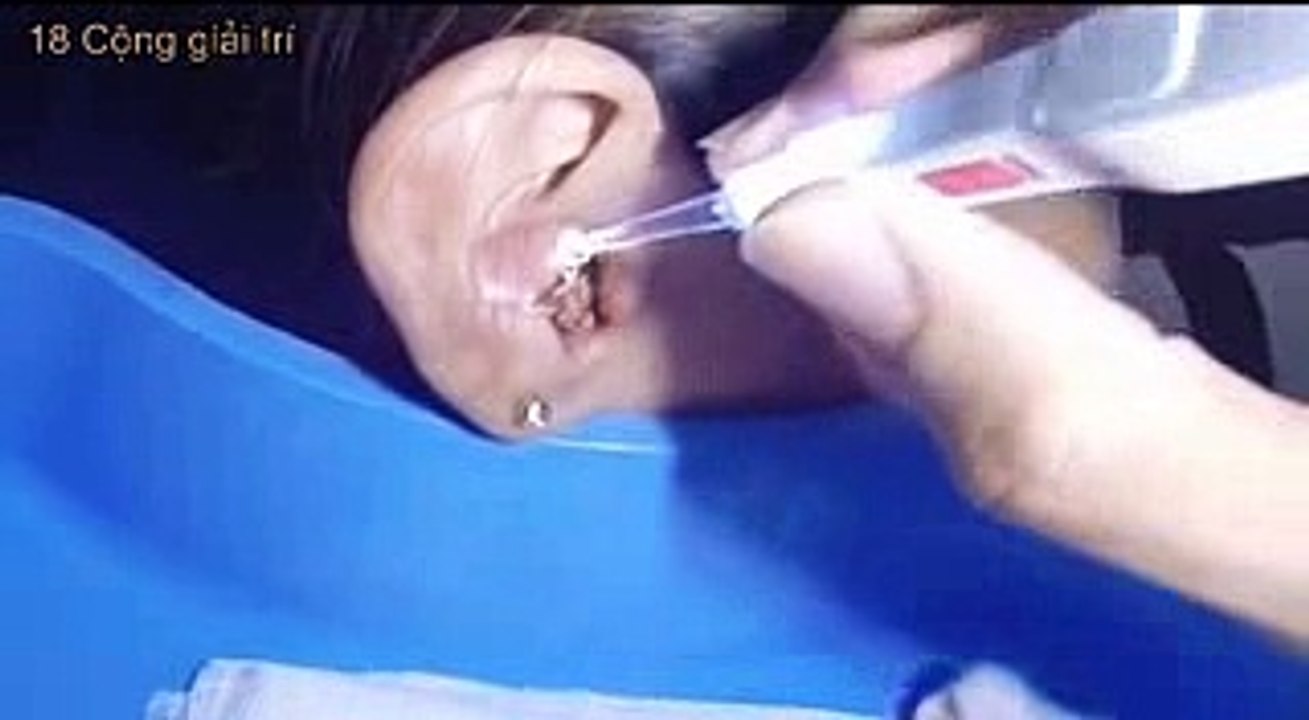 Gái Xinh Lấy Ráy Tai khổng lồ và Bốc mùi khiến bác sĩ cũng phải bó tay