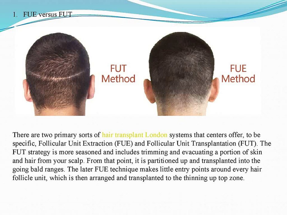 10_Must_Know_Tips_Before_Getting_Hair_Transplants