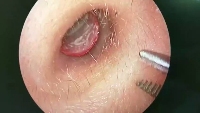 Ndodh në Shqipëri, ja çfarë hoqi ky doktor nga veshi i vajzës së re