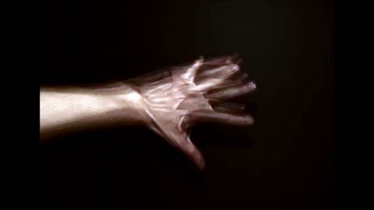 Alien Hand Syndrome