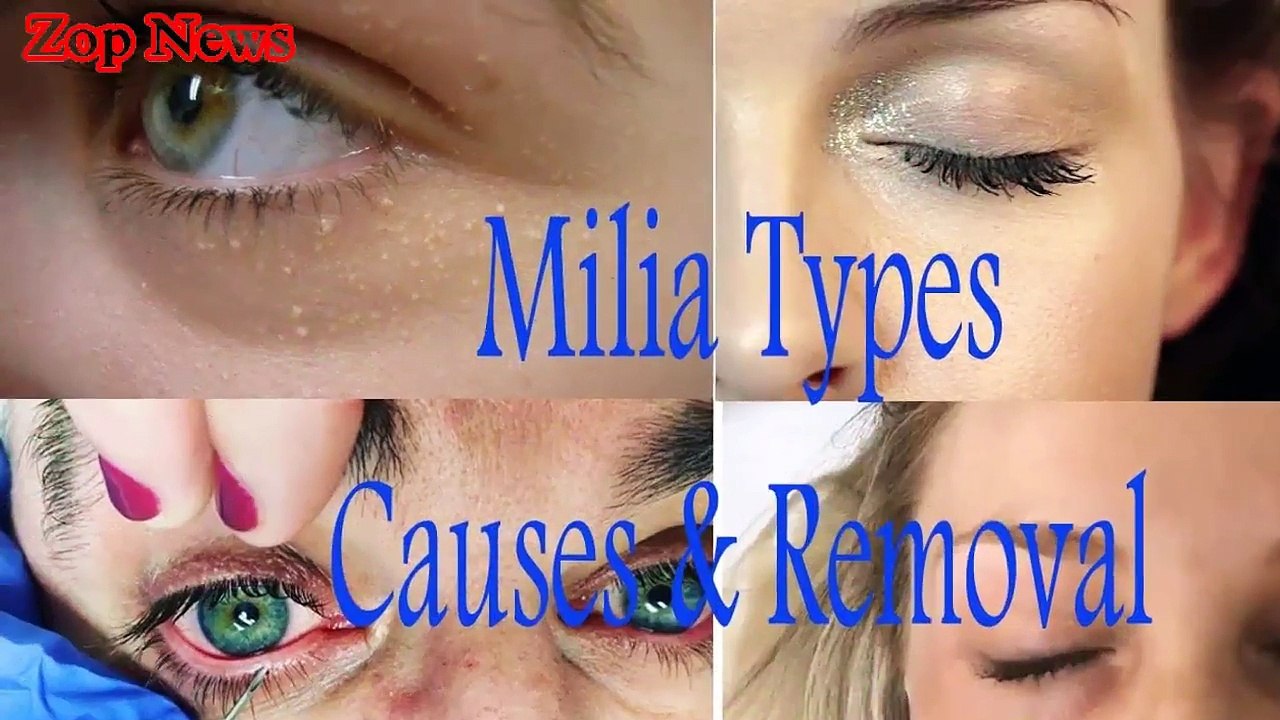 50.8 Tips to get Rid from Milia in Hindi
