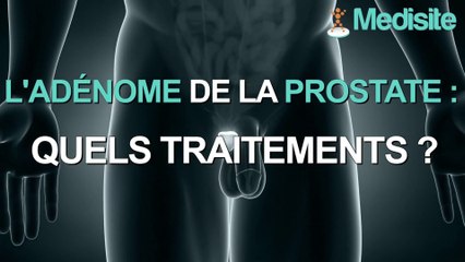Adénome de la prostate : quels traitements ?