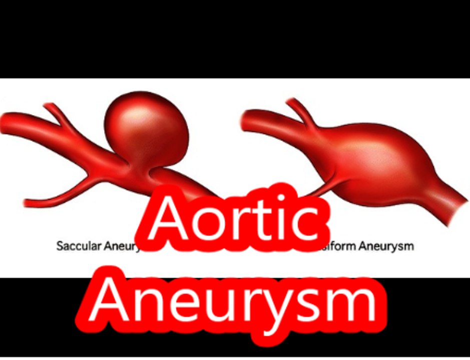 Aortic Aneurysm