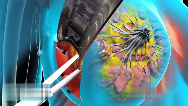 Рак молочной железы Хирургия | Лечение рака молочной железы