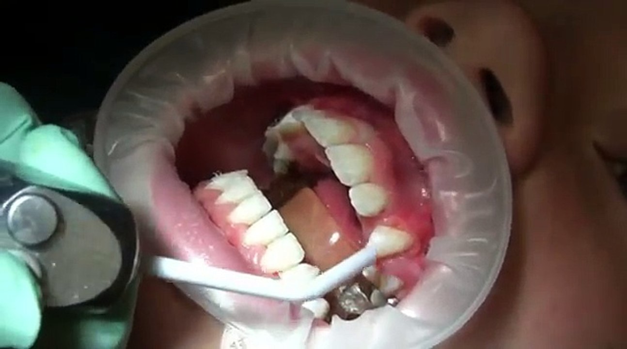 Watch how we put your braces on!