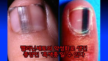 손톱으로 보는 당신의 8가지 건강상태