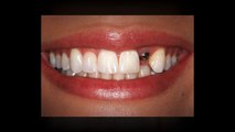 Single Tooth Dental Implants Treatment in Plantation