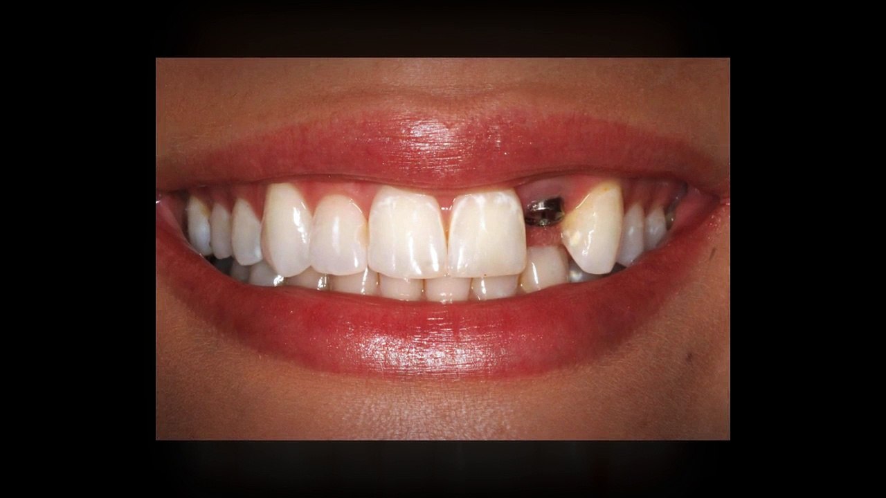 Single Tooth Dental Implants Treatment in Plantation
