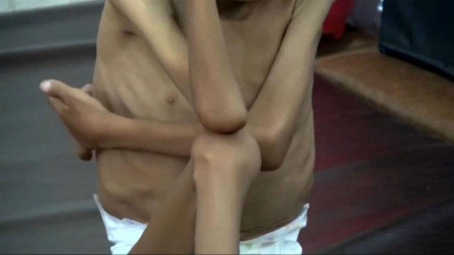 الأمم المتحدة تحذر من مجاعة تهدد الملايين ما لم تصل المساعدات إلى اليمن