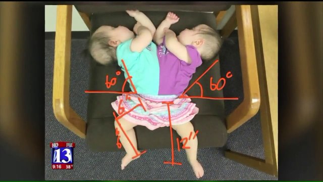 Conjoined Twins Get Big Help Toward Taking Their First Steps