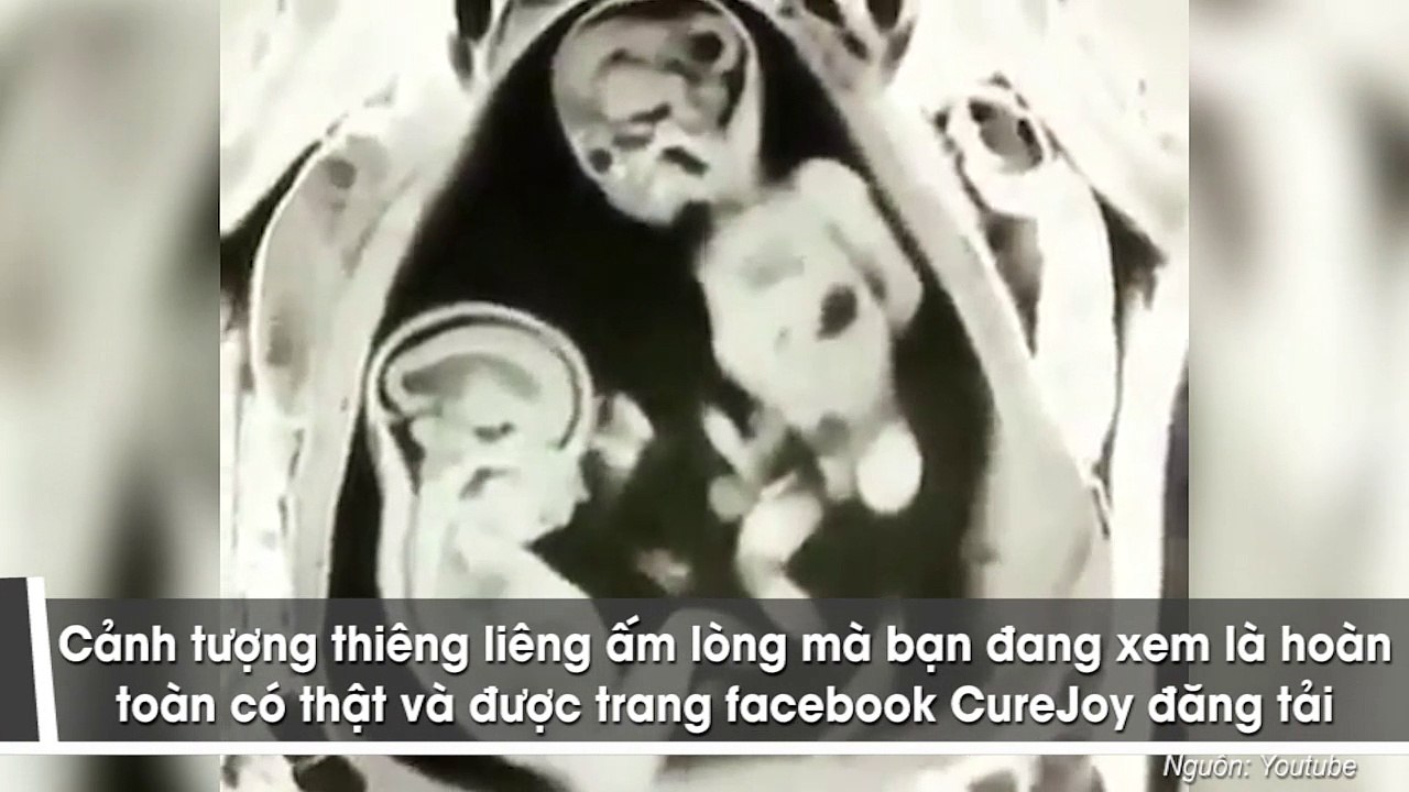 Hai em bé sinh đôi nằm trong bụng mẹ đánh nhau "dữ dội" để tranh nhau làm anh