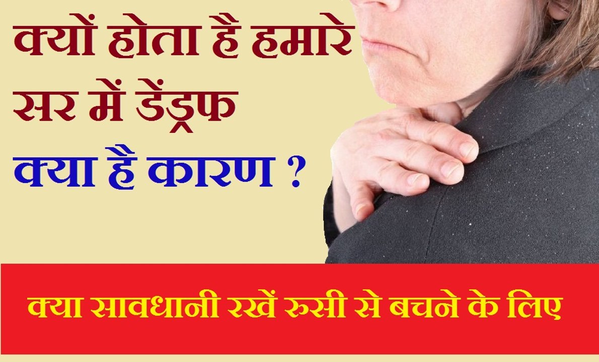 इन कारणों से होता है डैंड्रफ  | Reason of Dandruff - Get rid of Dandruff