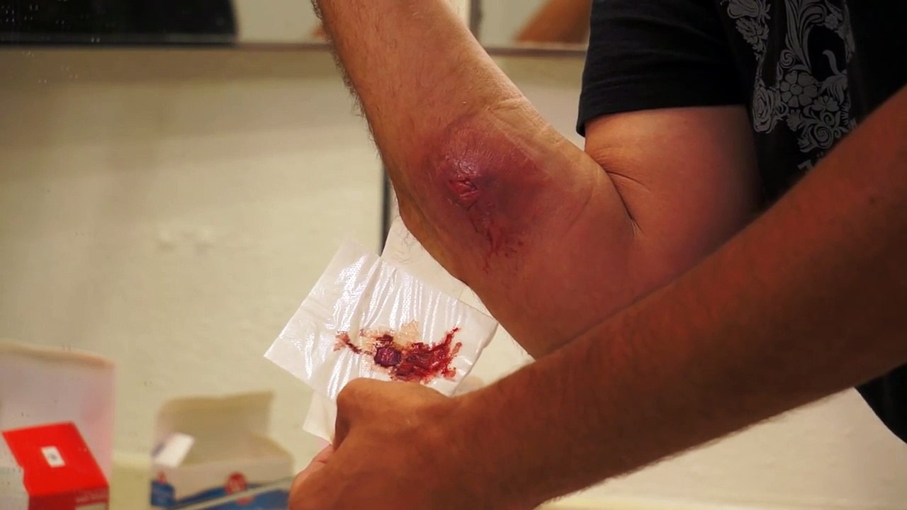 Spider Bite - Removing