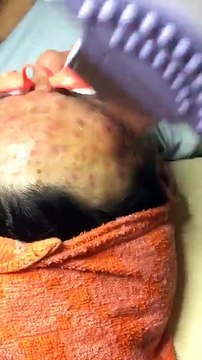 Trị thâm nám tàn nhang do mụn tạo nên mà Spa Thủ Đức chia sẽ lại