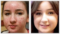 Remove Acne Scars - How to Remove Acne Scars From Face